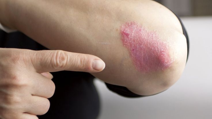 Para algunas afecciones cutáneas los dermatólogos pueden prescribir el uso de esteroides tópicos, pero solo bajo receta médica. (Getty Images).